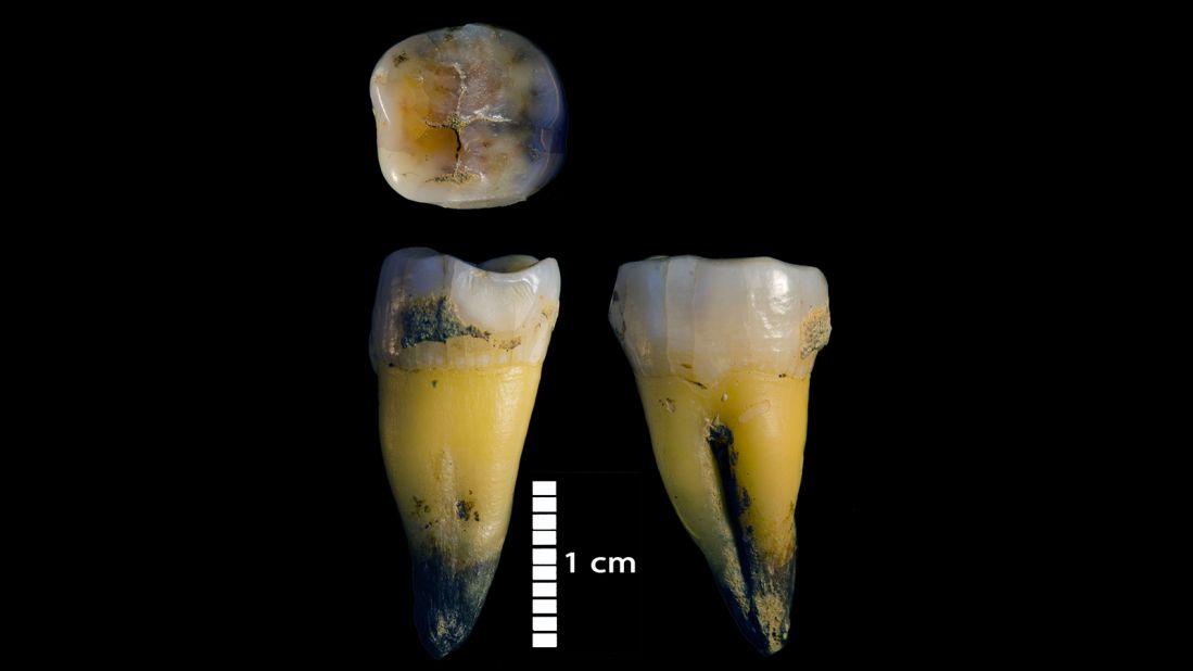 This is the second lower molar of a modern human found in Bacho Kiro Cave in Bulgaria that was associated with tools from Initial Upper Palaeolithic about 45,000 years ago.