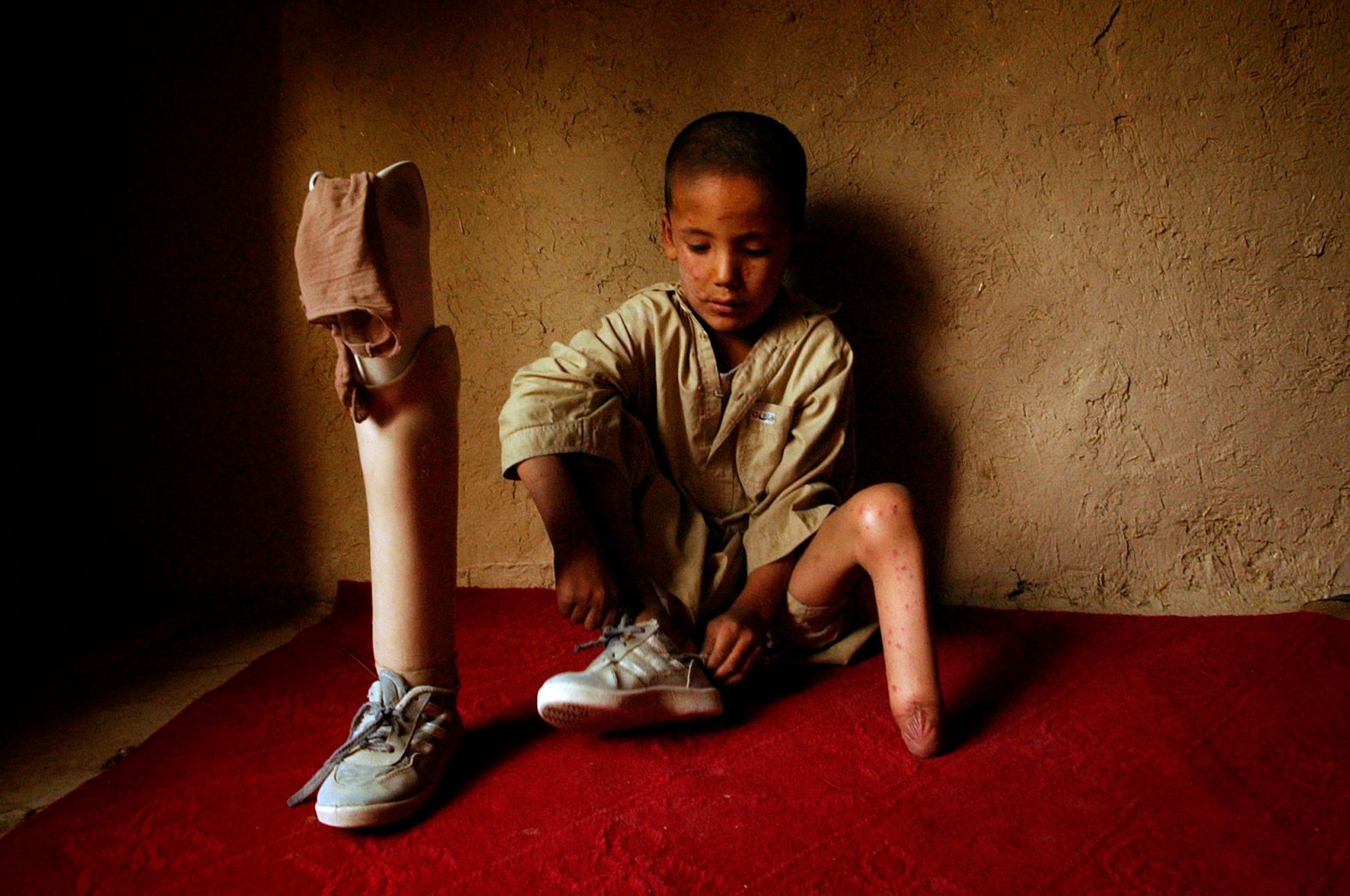Mohammaed Mahdi, who lost his foot in a mine explosion, waits for a Red Cross doctor at his home in Kabul in August 2004. This photo was taken by Associated Press photographer Emilio Morenatti, who five years later lost part of his leg when the armored vehicle he was in hit a roadside bomb.