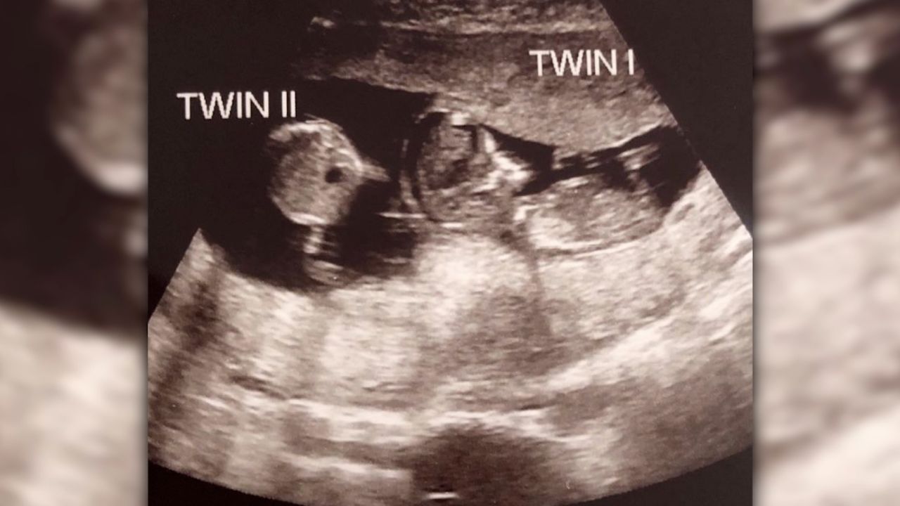 Baby Noah was joined in utero by fraternal twin Rosalie some three weeks after Noah's conception.