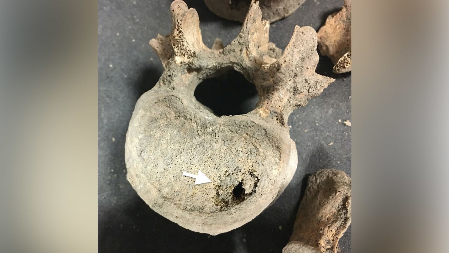 A human vertebra dating back to medieval times shows evidence of cancer metastases. 