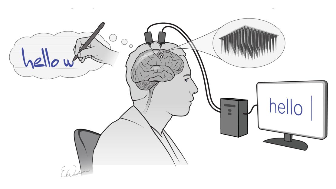 Two tiny sensors relayed information from the brain area that controls the hands and arms to an algorithm, which translated it into letters that appeared on a screen.