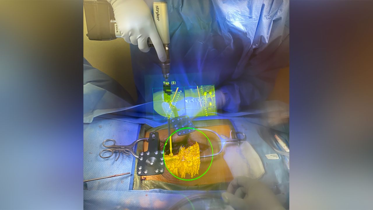 Using an AR headset called "xvision," surgeons at Johns Hopkins Medicine can see layered digital images in real time during procedures.