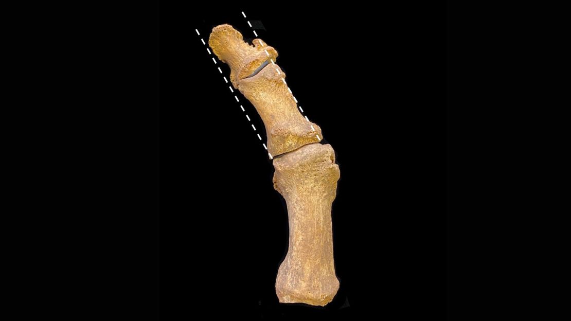 Excavated medieval foot bones show a bunion, with lateral deviation of the big toe. 