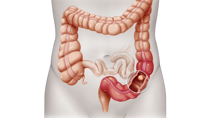 Colonoscopy: What You Need to Know After Studies Question Its Effectiveness