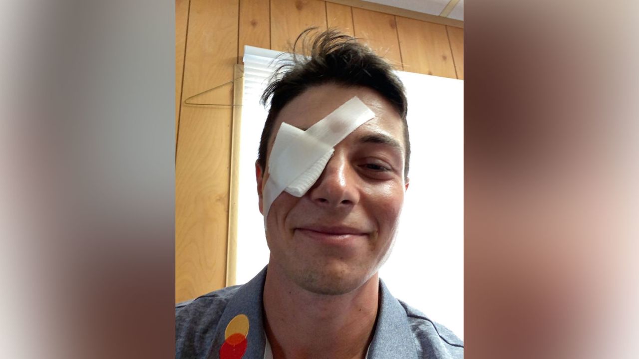 Hovland posted a photo of his injured eye on Instagram.