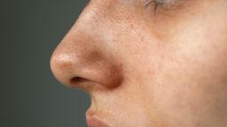 blackheads on the nose of a teenager closeup