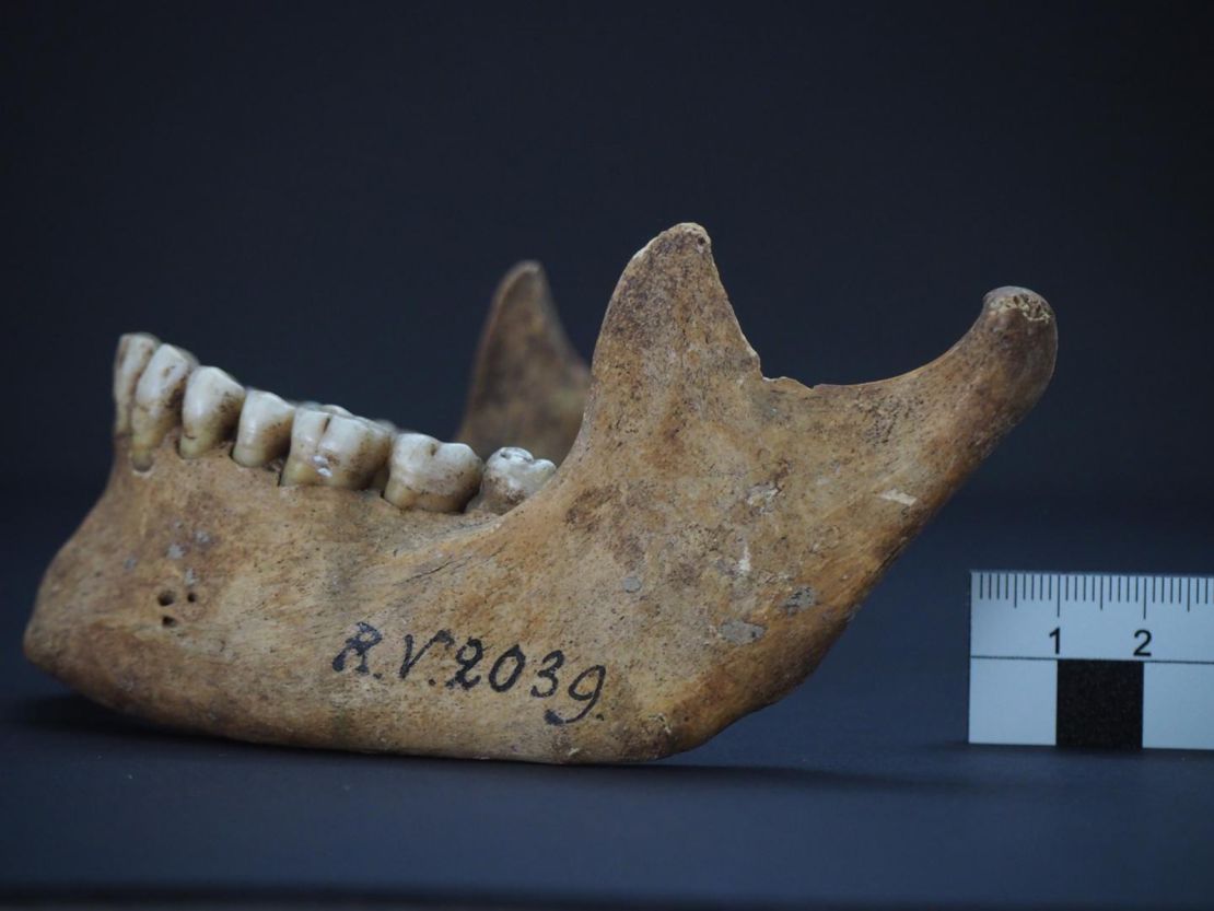 The jawbone of the man who was buried in Rinnukalns, Latvia, around 5,000 years ago.