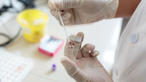 Bai Jinhua, the head of microbiology at Meng La County People's Hospital in China's Yunnan province, examines a blood smear for malaria parasites in April 2019.