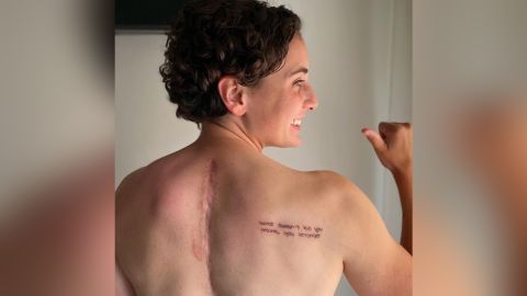 Carrasco shows the scars that resulted from the accident and surgery.