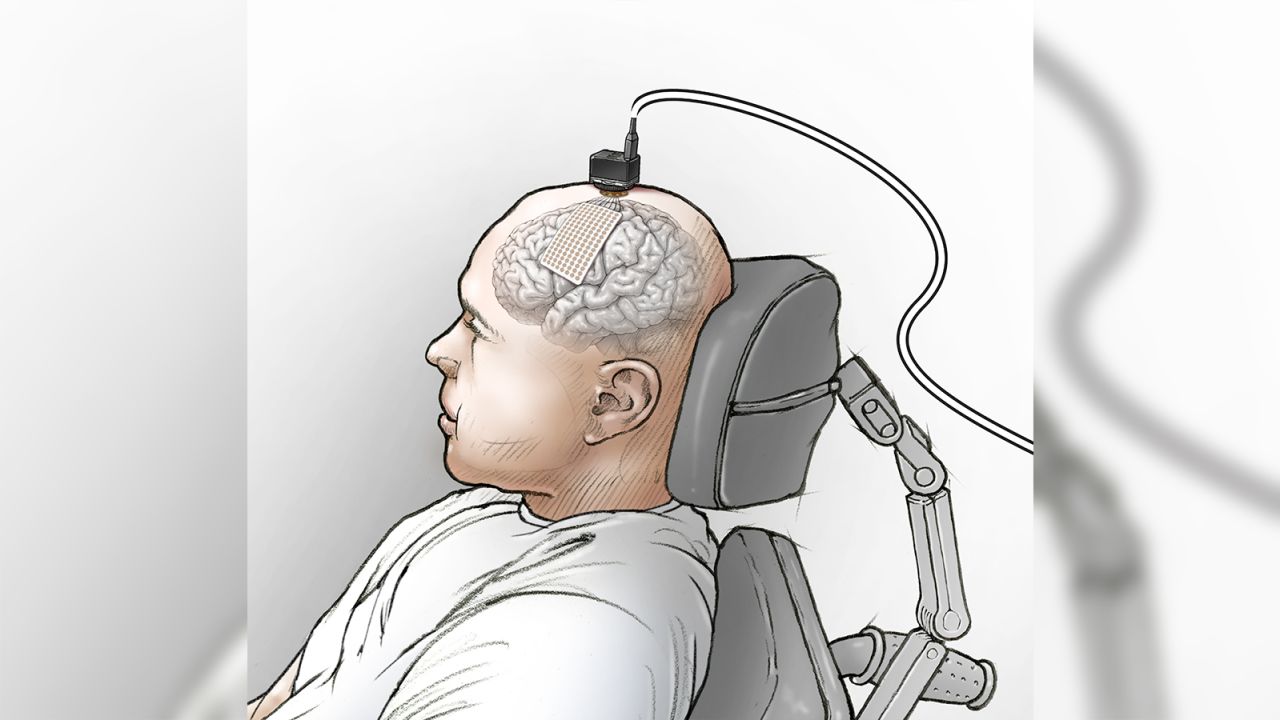 Illustration showing placement of the eCOG electrode on the participant's speech motor cortex and the head stages used to connect the electrode to the computer.