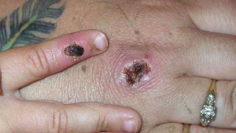 In this Centers for Disease Control and Prevention handout graphic, symptoms of one of the first known cases of the monkeypox virus are shown on a patient's hand June 5, 2003. (Photo Courtesy of CDC/Getty Images) 