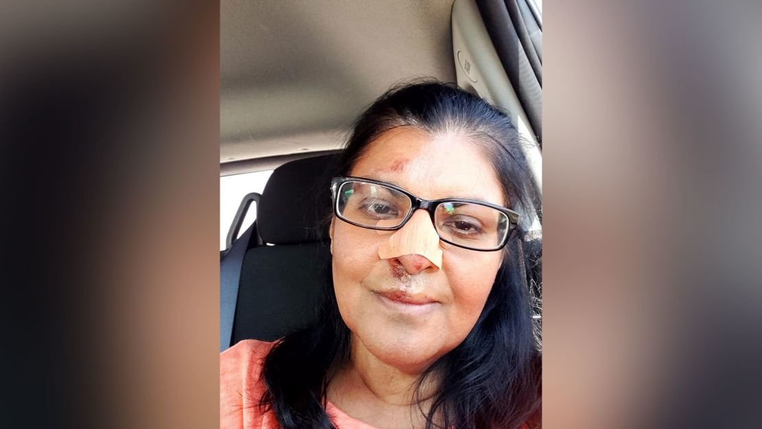 Minnie John received five stitches and was told she had a fractured nose