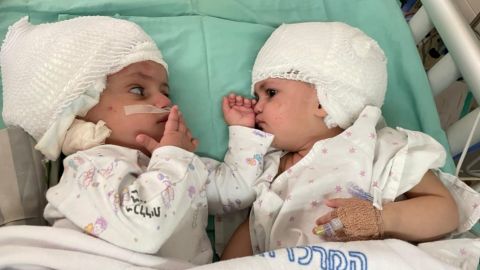 The twins can now face each other, for the first time since they were born a year ago.