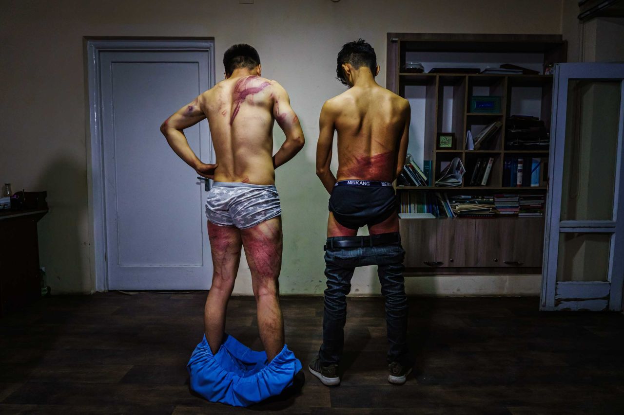 Journalists from the Etilaatroz newspaper — video journalist Nemat Naqdi, left, and video editor Taqi Daryabi — undress to show wounds they sustained after Taliban fighters tortured and beat them while in custody. They had been arrested while reporting on a women's rights protest in Kabul on September 8.