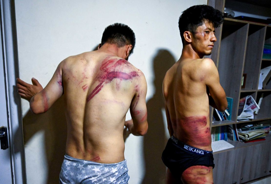 EtilaatRoz journalists Nematullah  Naqdi, left, and Taqi Daryabi show their wounds at their office in Kabul on September 8, after being released from Taliban custody.