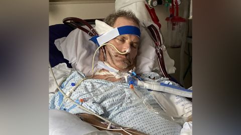 Robby Walker's blood is removed and returned during ECMO treatment.