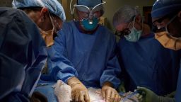 In this September 2021 photo provided by NYU Langone Health, a surgical team at the hospital in New York examines a pig kidney attached to the body of a deceased recipient for any signs of rejection. From left are Drs. Zoe A. Stewart-Lewis, Robert A. Montgomery, Bonnie E. Lonze and Jeffrey Stern. The test was a step in the decades-long quest to one day use animal organs for life-saving transplants. (Joe Carrotta/NYU Langone Health via AP)