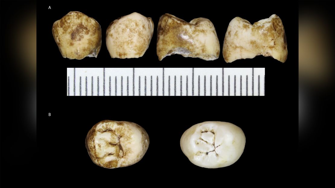 This image shows Leti's unemerged permanent premolar teeth.