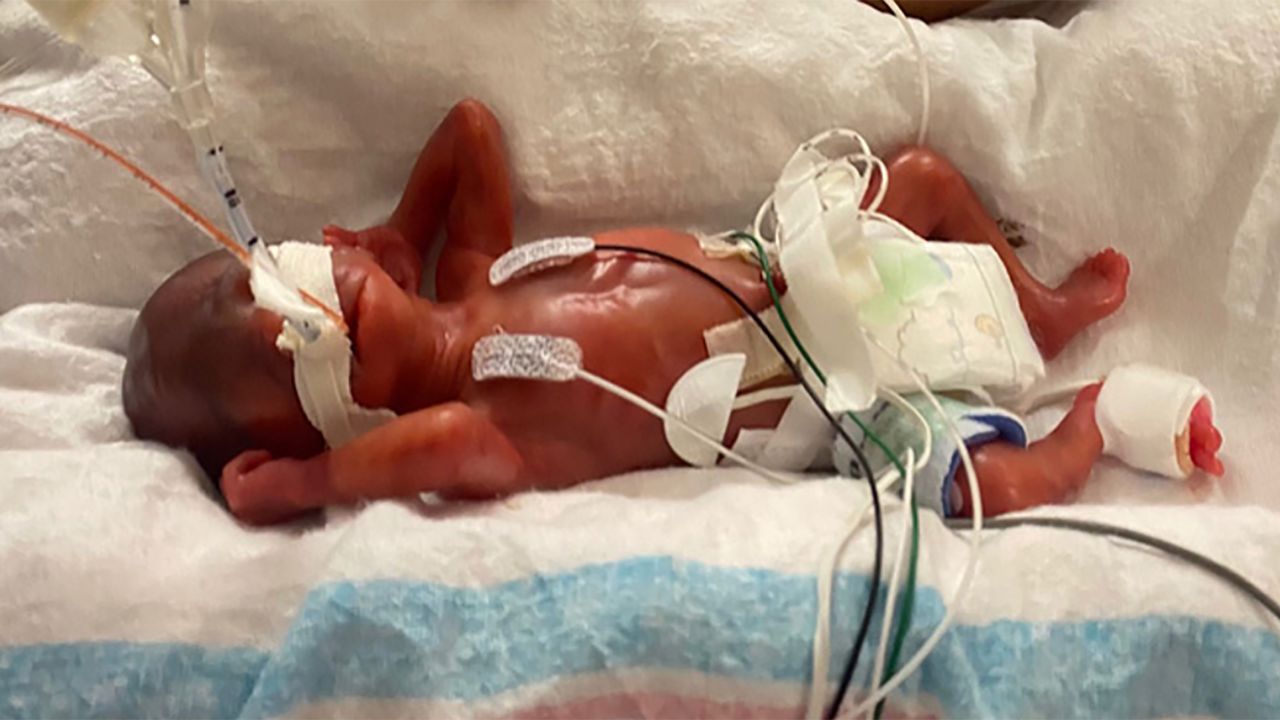 Curtis weighed just 14.8 ounces on the day of his birth and immediately was put on a ventilator.