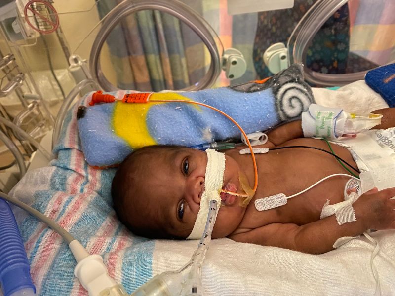 An Alabama baby was born less than 1 pound and at 21 weeks. Now he