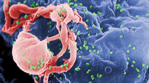 The patient, eight years after she was first diagnosed, shows no signs of active infection and shows no signs of intact virus anywhere in her body, researchers say.