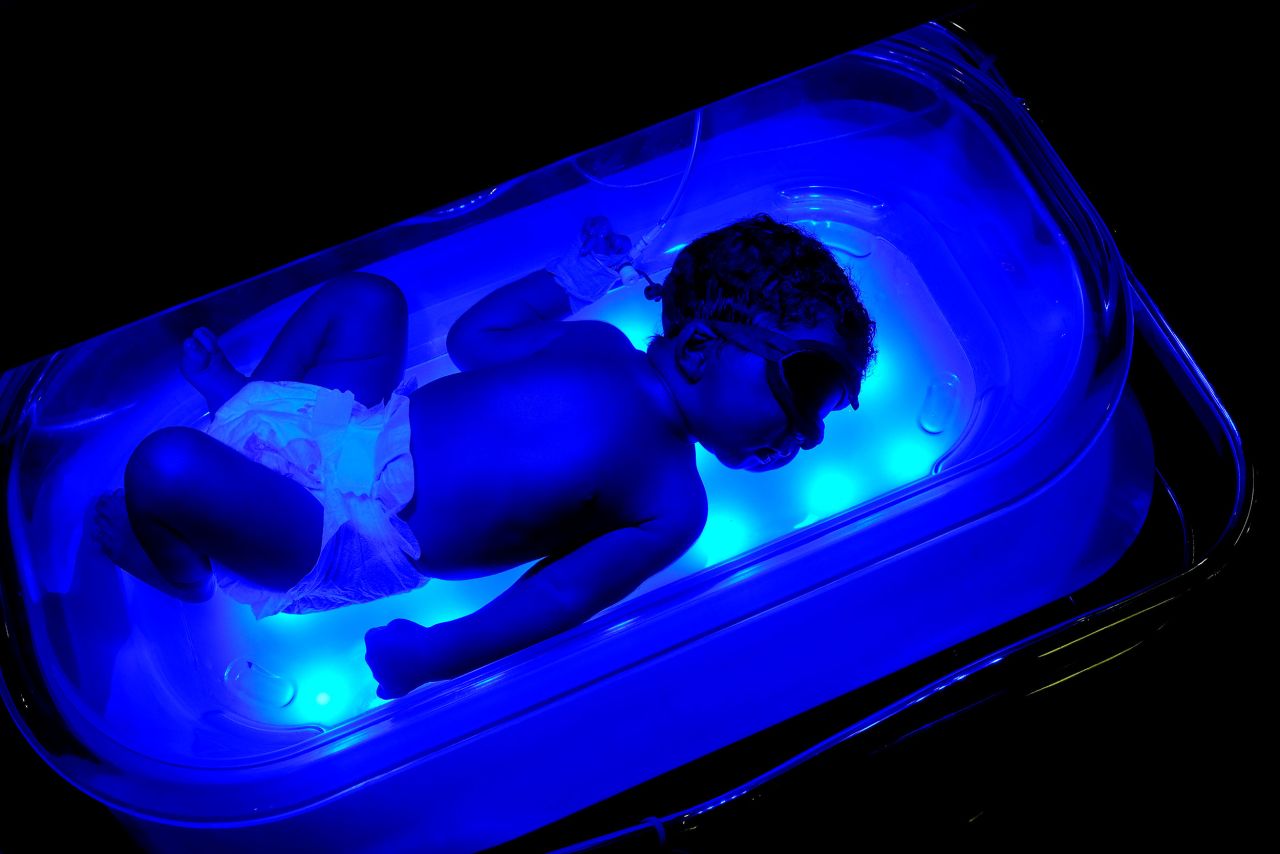 A baby undergoes a phototherapy treatment at the St. Damien Pediatric Hospital in Port-au-Prince, Haiti, on Friday, November 12. The blue lights are commonly used to treat newborn jaundice.