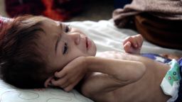 afghanistan starvation baby coren