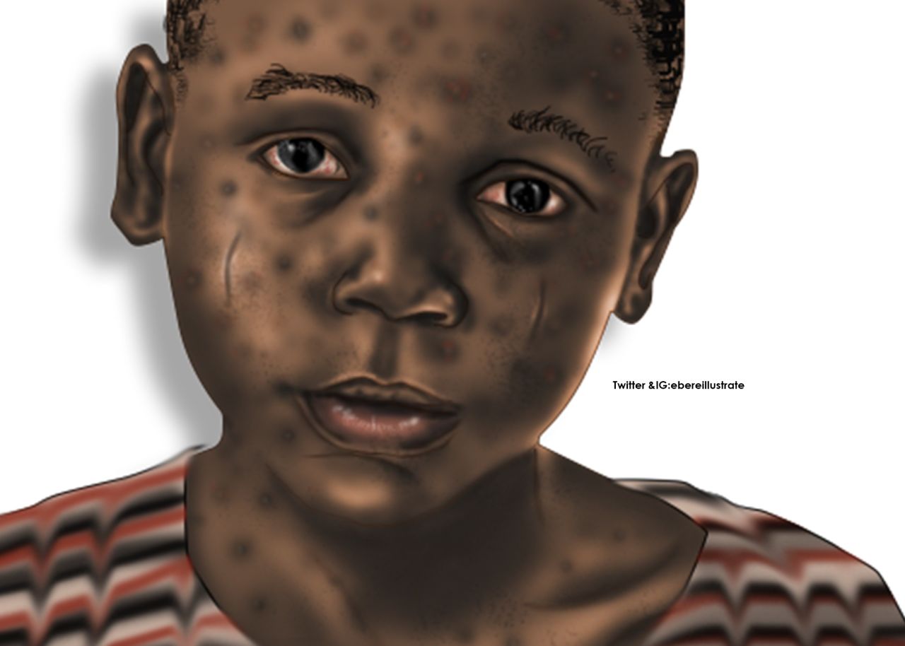 Ibe only started creating medical illustrations in 2020. On White skin, chicken pox is <a href="https://www.nhs.uk/conditions/chickenpox/" target="_blank" target="_blank">known to appear</a> as red spots. Here, he depicts how chicken pox might appear on dark skin, with hyperpigmentation.