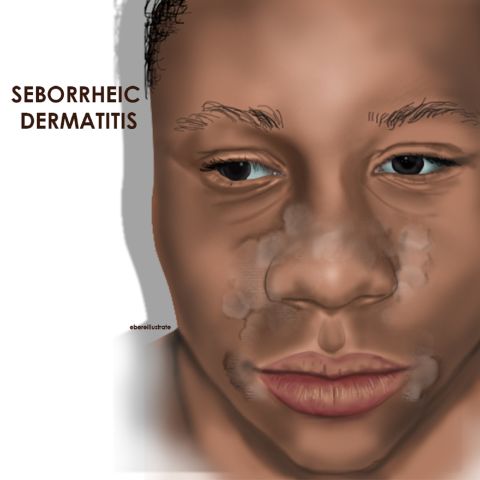 Seborrheic dermatitis is a common rash that causes red, scaly, greasy skin. However, on people with dark skin, the affected area may instead <a href="https://www.webmd.com/skin-problems-and-treatments/ss/slideshow-seborrheic-dermatitis-overview" target="_blank" target="_blank">appear</a> lighter than the surrounding skin.