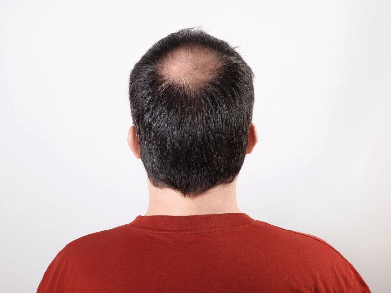 Details 148+ front hair loss male super hot