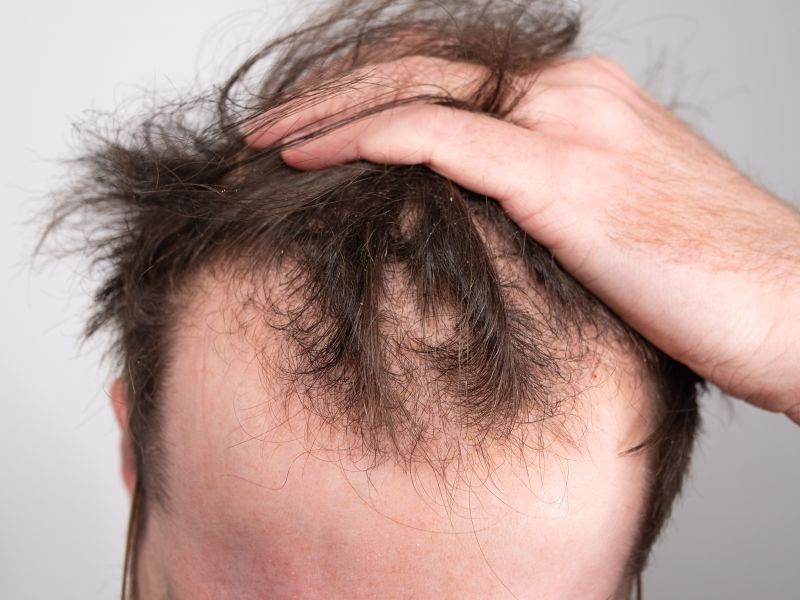 Low Dose Minoxidil Pill Prescribed For Early Hair Loss  Hair Restoration  of the South