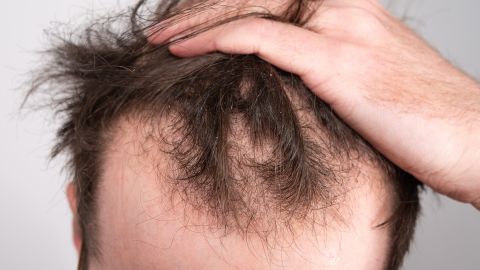 Male-pattern baldness affects most men at one point in their lives.