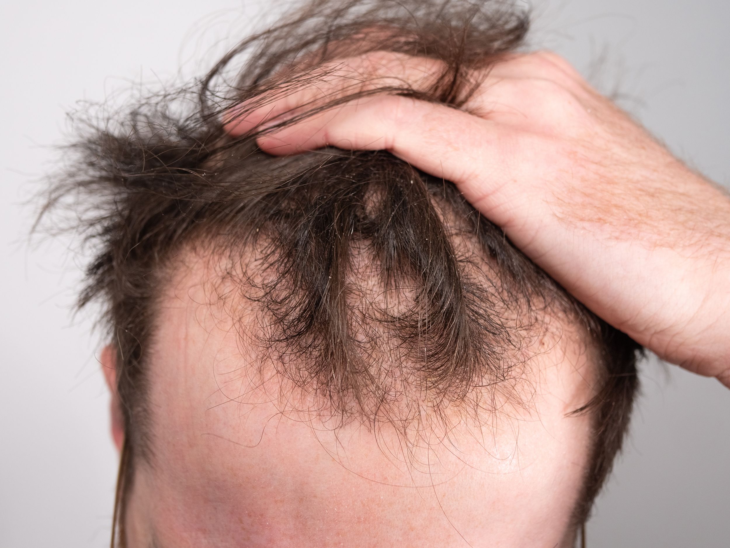One male hair loss treatment works better than study finds |