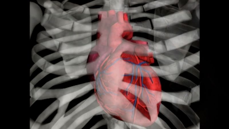 Combination 'polypills' can help solve world's heart problems, experts say, if more people can get them