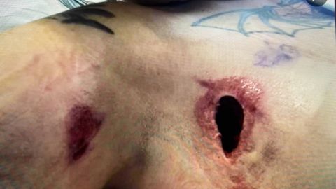 This image shows an injury sustained by Nicole Underwood, one alleged victim.