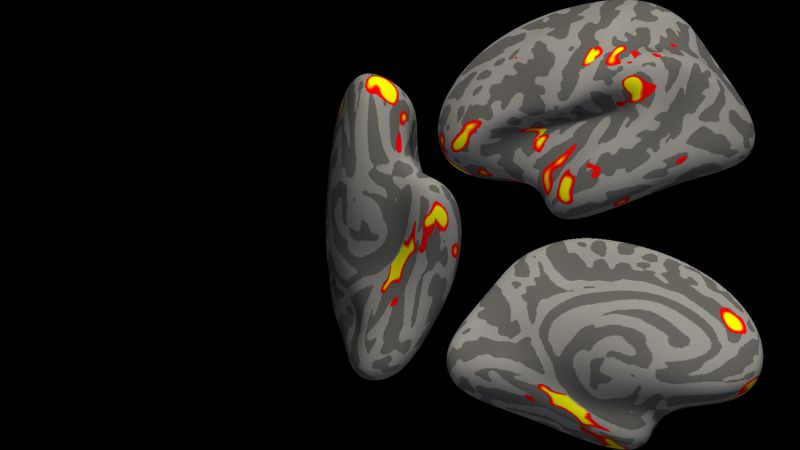 Une étude établit un lien entre un Covid-19 même léger et des changements dans le cerveau