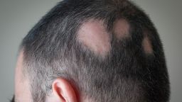 alopecia areata STOCK