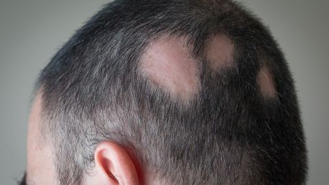 Alopecia areata begins with one or more small bald patches, typically on a person's scalp. 