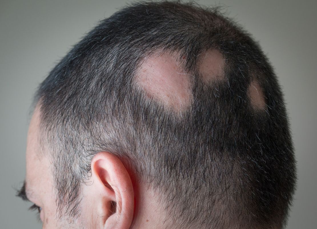 Alopecia areata begins with one or more small bald patches, typically on a person's scalp. 