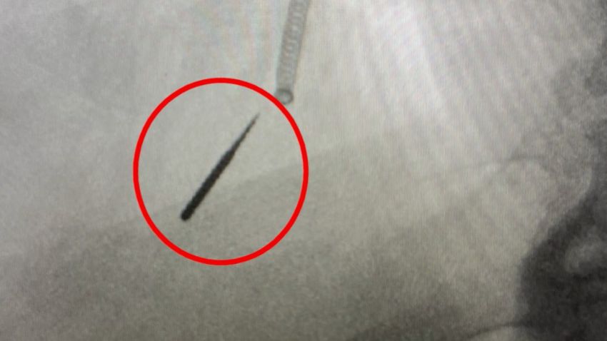 Dentist drill bit in lung
