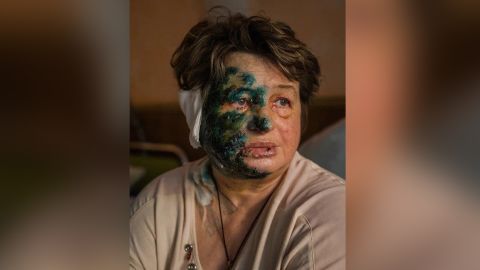 Halyna Moroskhovskaya, 59, pictured with antiseptic on her face in a Mariupol hospital, after coming under attack.