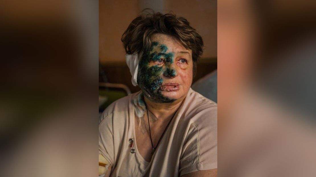 Halyna Moroskhovskaya, 59, pictured with antiseptic on her face in a Mariupol hospital, after coming under attack.