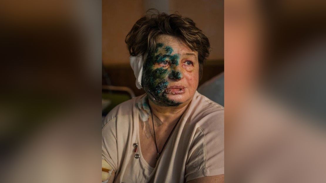 Halyna Moroskhovskaya, 59, pictured with antiseptic on her face in a Mariupol hospital, after coming under attack.