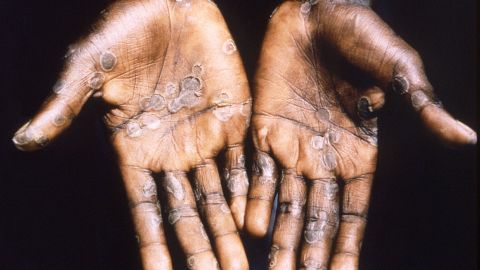 The palms of a monkeypox diligent  successful  the Democratic Republic of Congo are seen during a 1997 wellness  investigation.