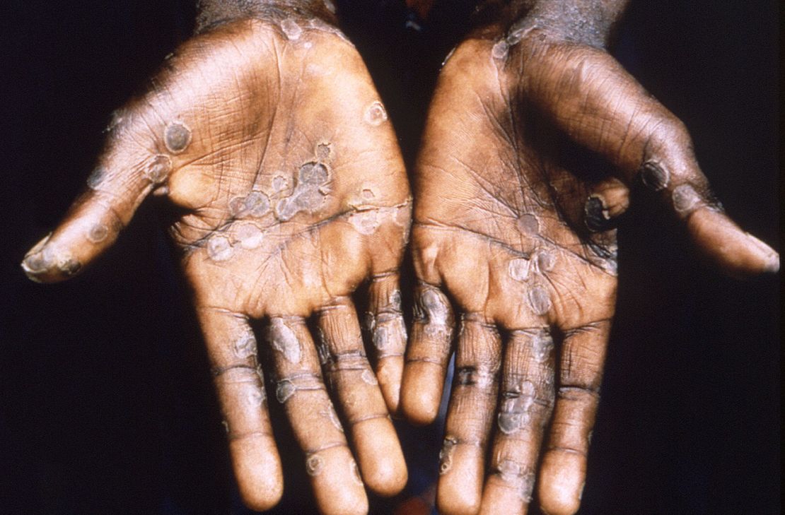 The palms of a monkeypox case patient  in the Democratic Republic of Congo in 1997.