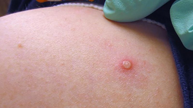 Monkeypox Pictures: How to Identify Symptoms of Monkeypox