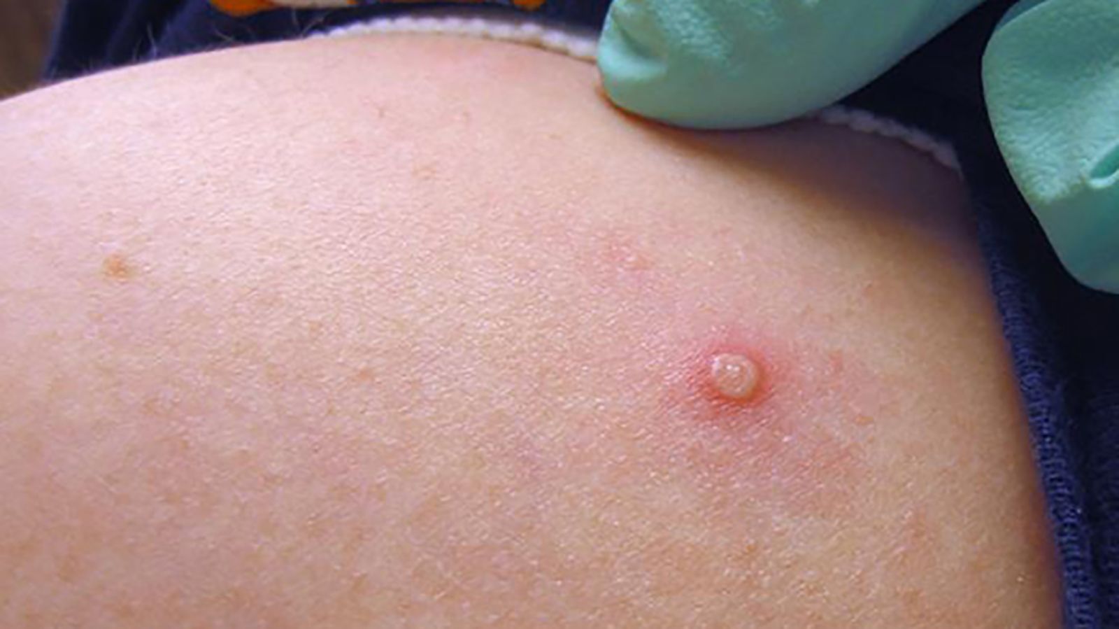 Monkeypox rash and scars: What does monkeypox look like? - ABC News