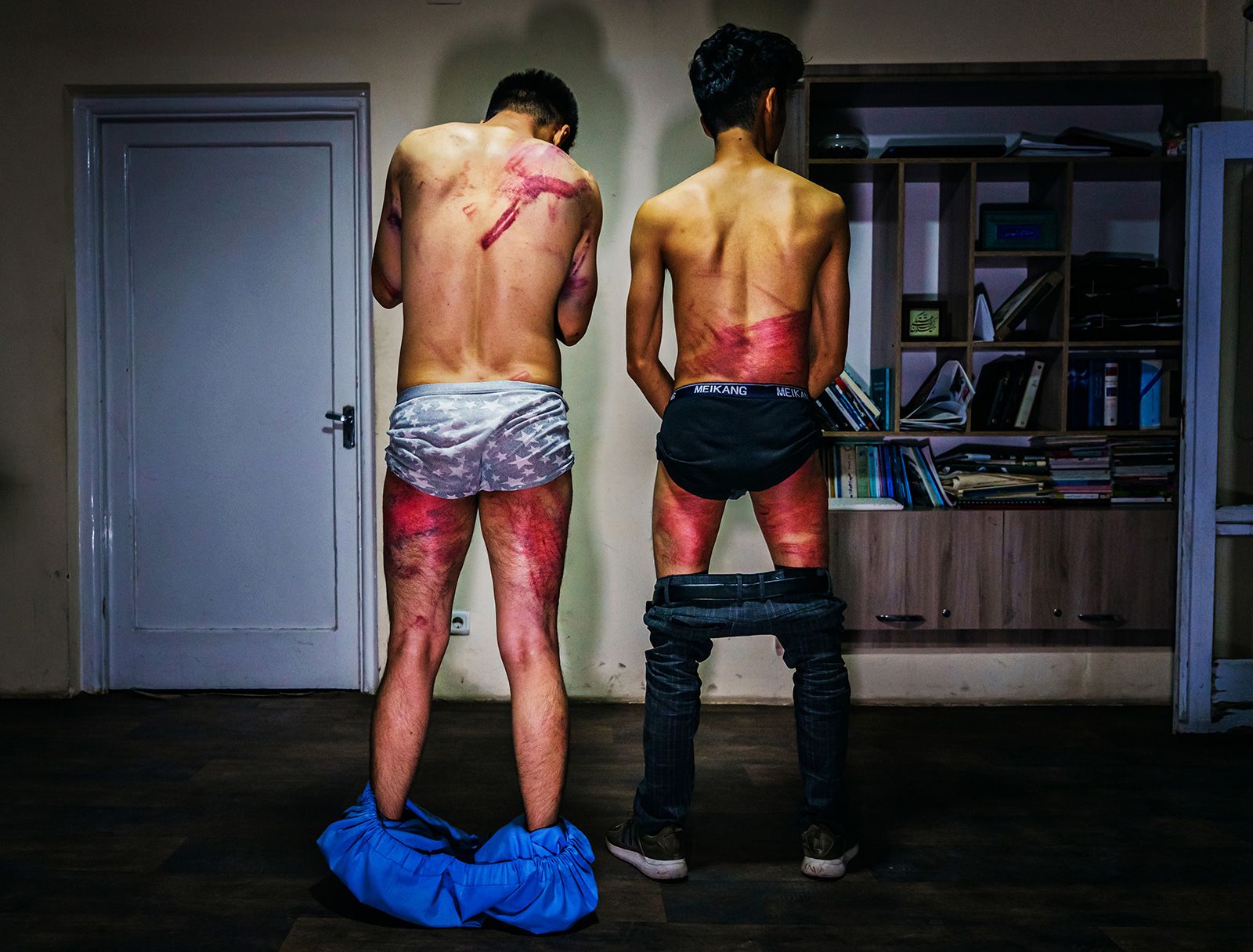 September 8, 2021: Two journalists, Nemat Naqdi and Taqi Daryabi show the wounds caused by torture from Taliban fighters in Kabul. They were beaten while in custody -- after being held for recording a rally for women's rights.