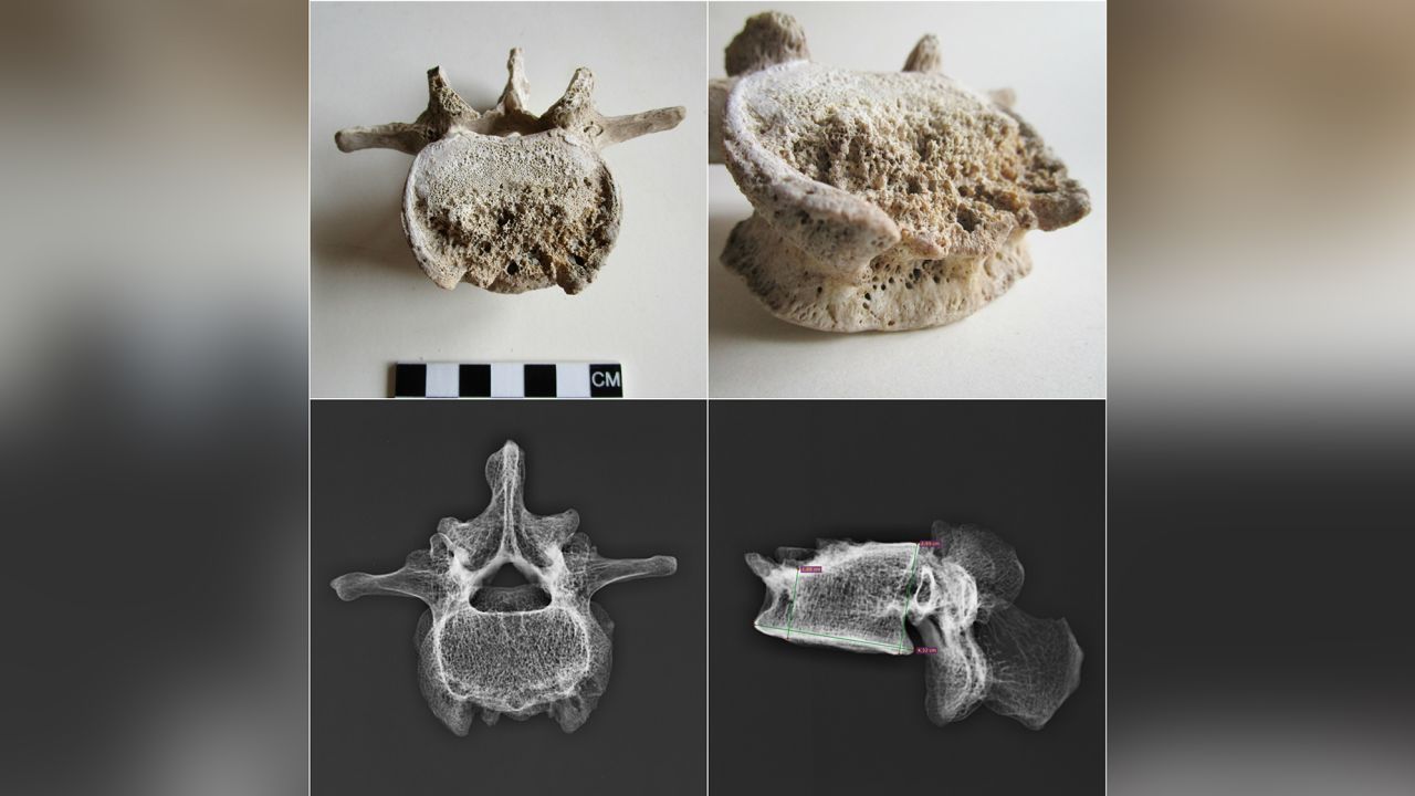 Lesions on the male individual's lumbar vertebrae, which are the five bones between the rib cage and the pelvis, suggests that he suffered from tuberculosis before he died. 