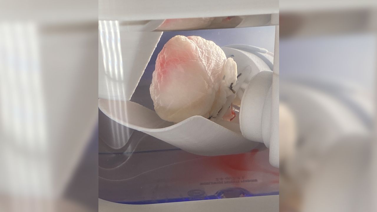 A pig-based 'ghost heart' created by Dr. Doris Taylor is in the process of being injected with human stem cells.